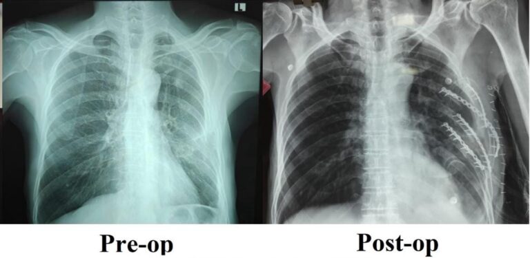 SRM Medical College Hospital and Research Centre Performs Its First Rib Stabilisation Surgery